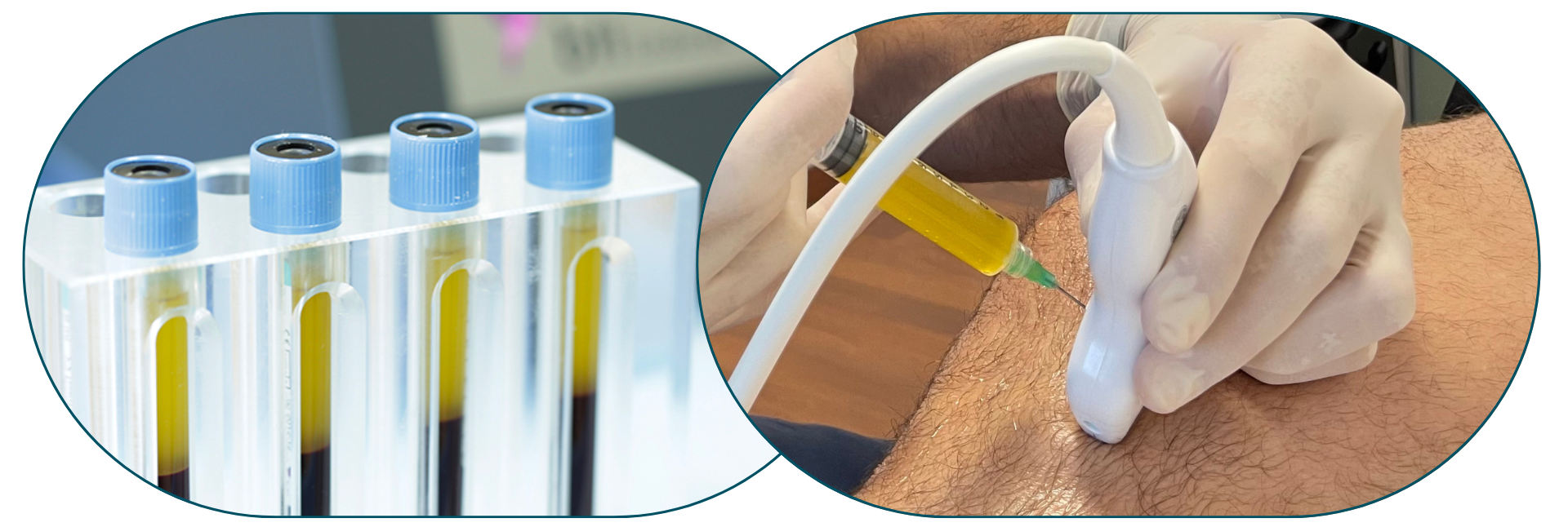El PRP (Plasma Rico en Plaquetas) es una de las terapias más avanzadas y efectivas en medicina regenerativa y medicina deportiva. Utiliza componentes biológicos del propio paciente para acelerar la reparación del tejido.
